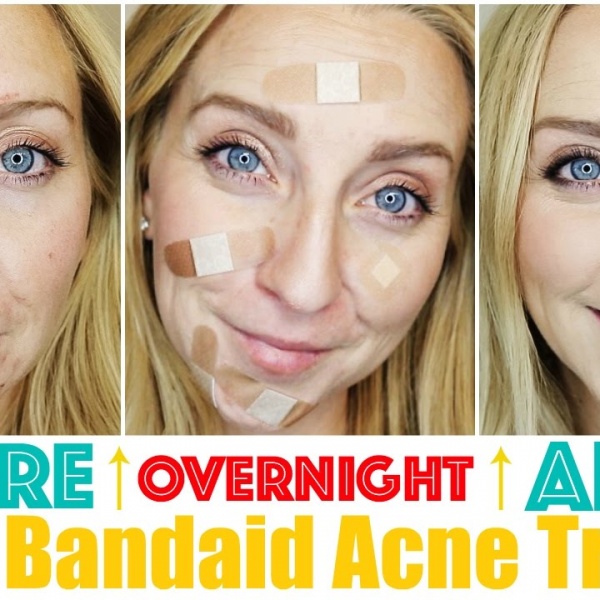 How to Get Rid of Acne Fast & OVERNIGHT with My Bandaid Trick!